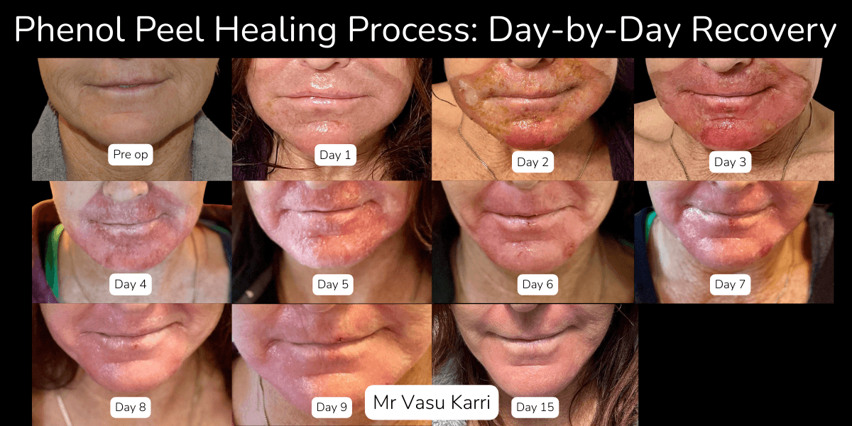 Phenol Peel Aftercare: The Complete Do's and Don'ts