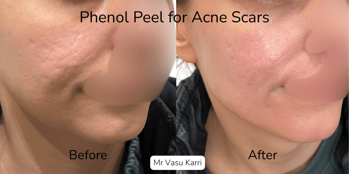 Phenol Peel for Acne Scars: What to Expect