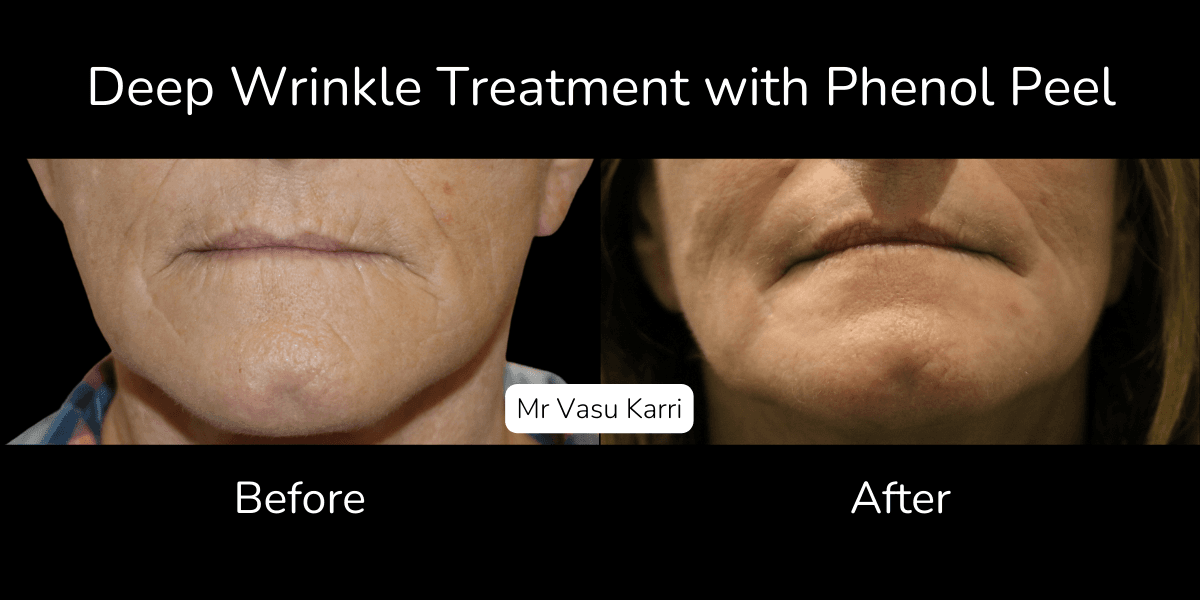 Does a Phenol Peel Remove Deep Wrinkles?