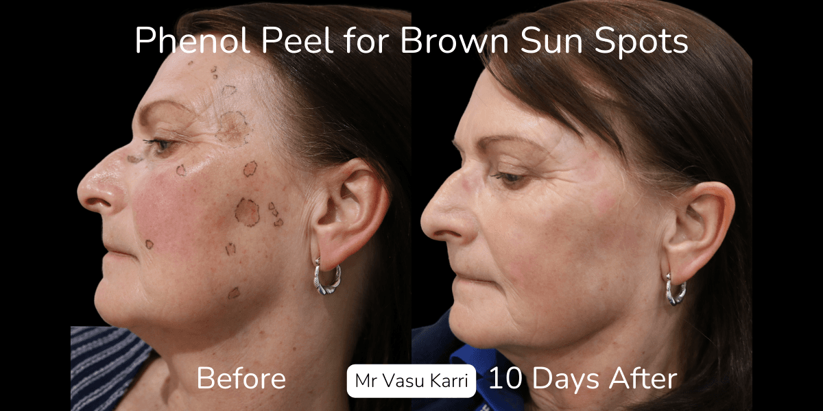Phenol Peel vs Laser Resurfacing: Pros and Cons