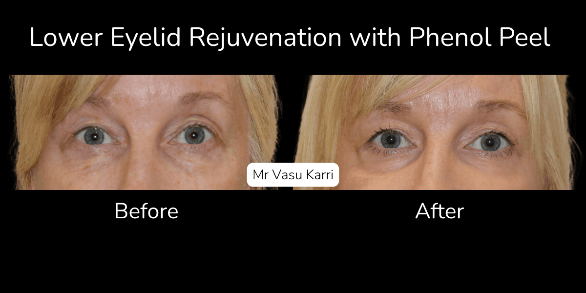 Phenol Peel Aftercare and Long-Term Maintenance