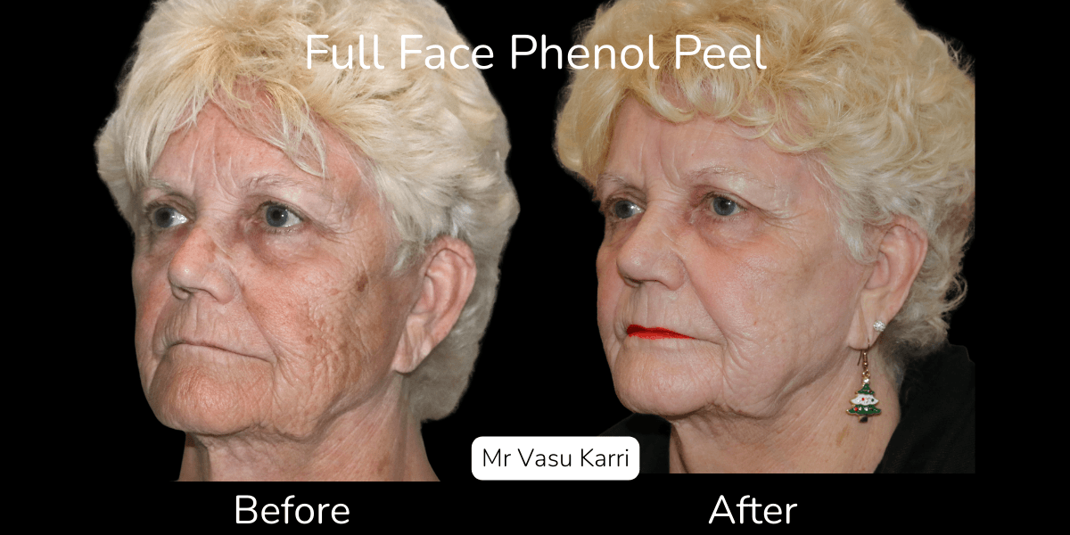 Does a Phenol Peel Tighten Skin? Long-Term Effects on Laxity
