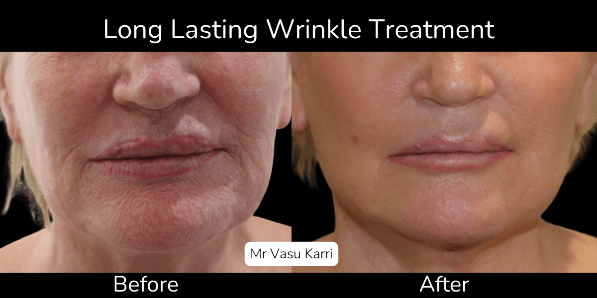 The Phenol Peel Procedure: From Consultation to Final Results