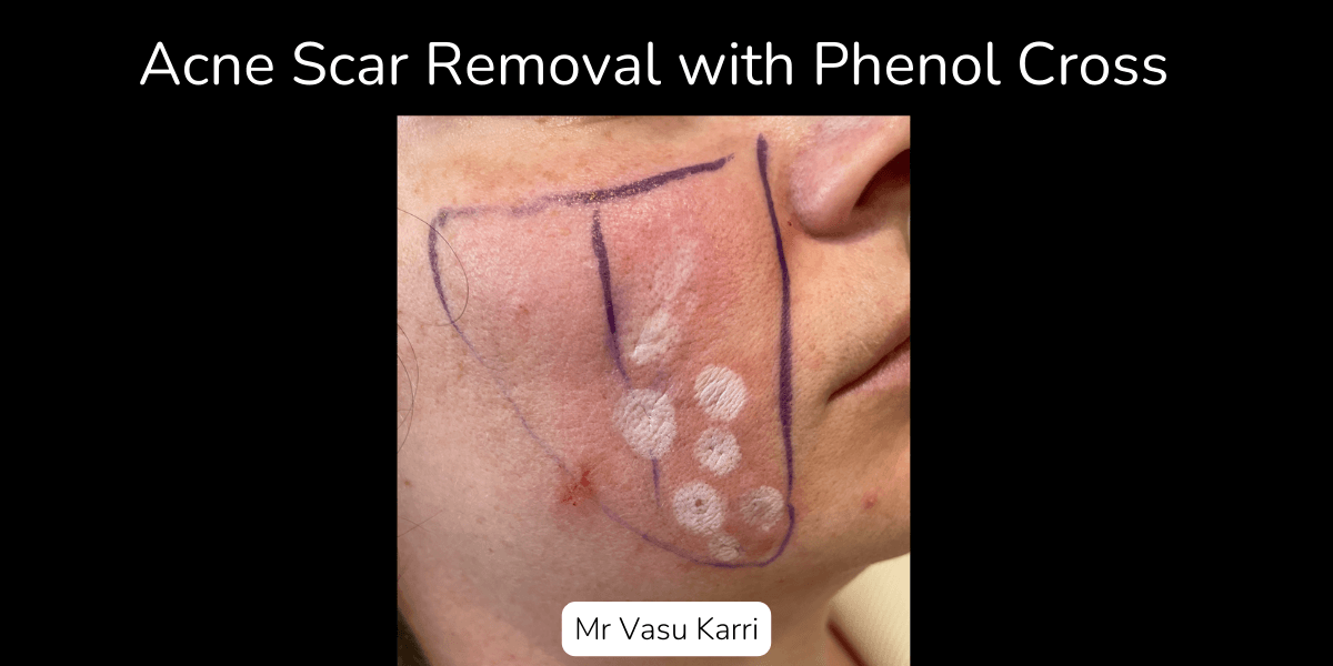 Phenol Skin Peel Cost and Value Analysis