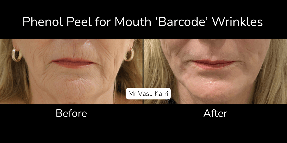 How Long Do Phenol Peel Results Last?
