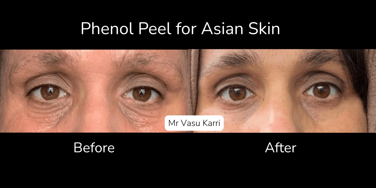 Phenol Peel Benefits and Results