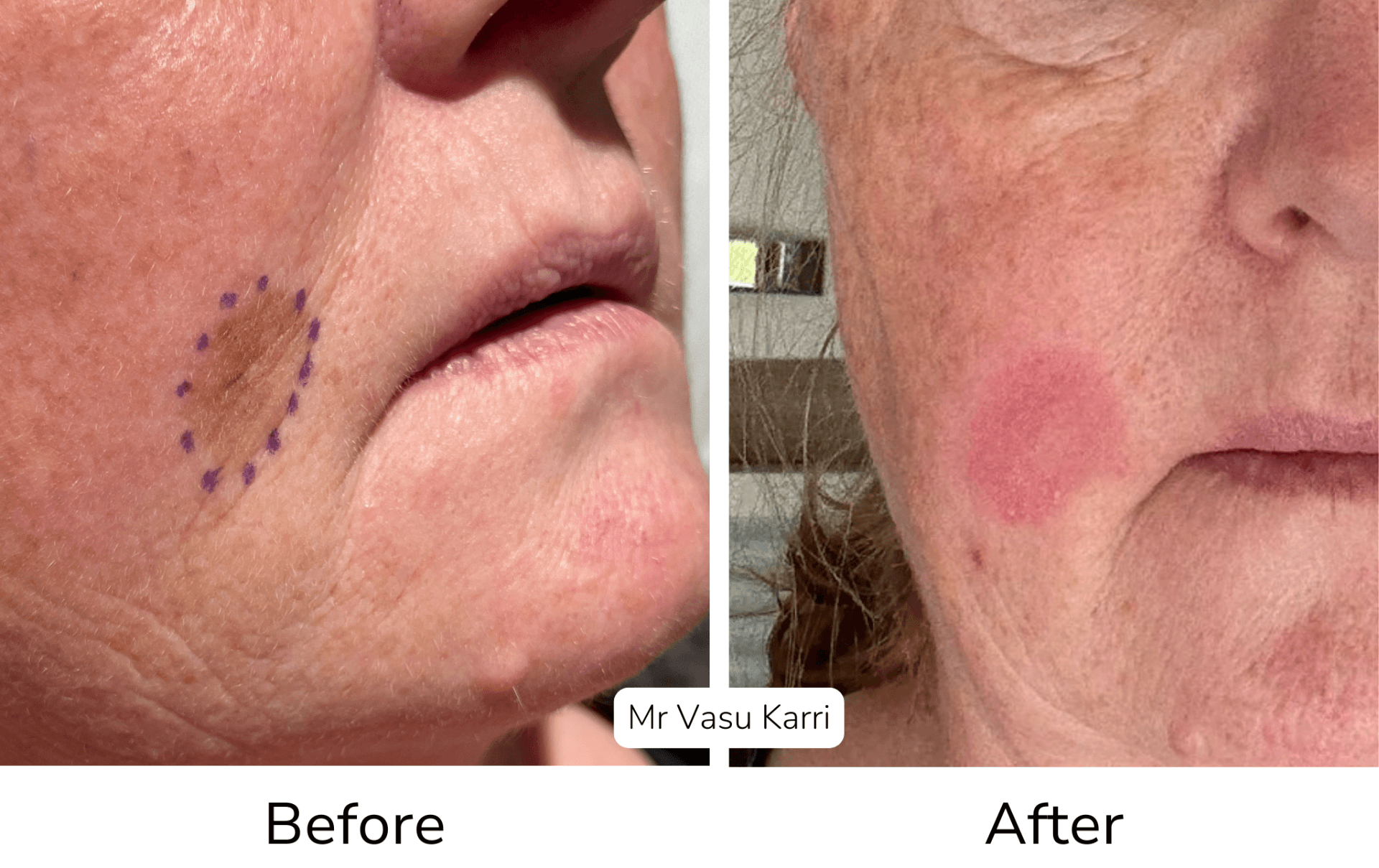 Phenol peel before and after showing hyperpigmentation improvement