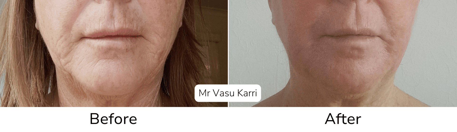 Phenol peel before and after showing mouth area wrinkle improvement