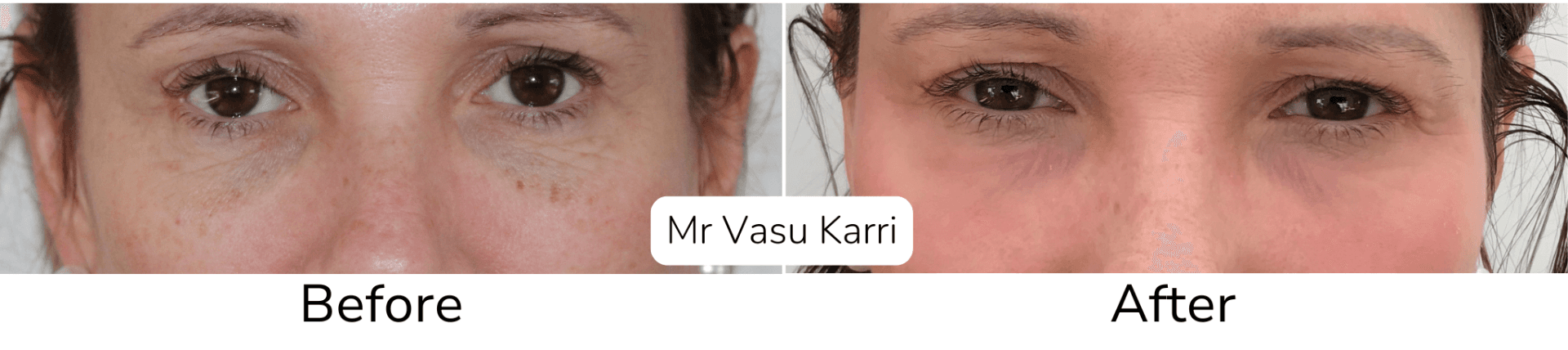 Lower eyelid dark circles before after