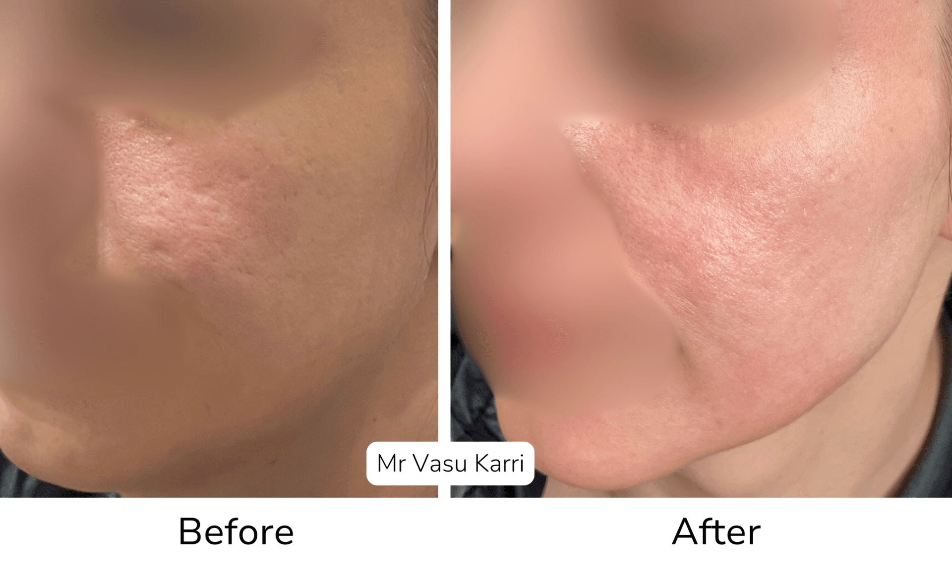 Phenol peel before and after showing acne scarring treatment results