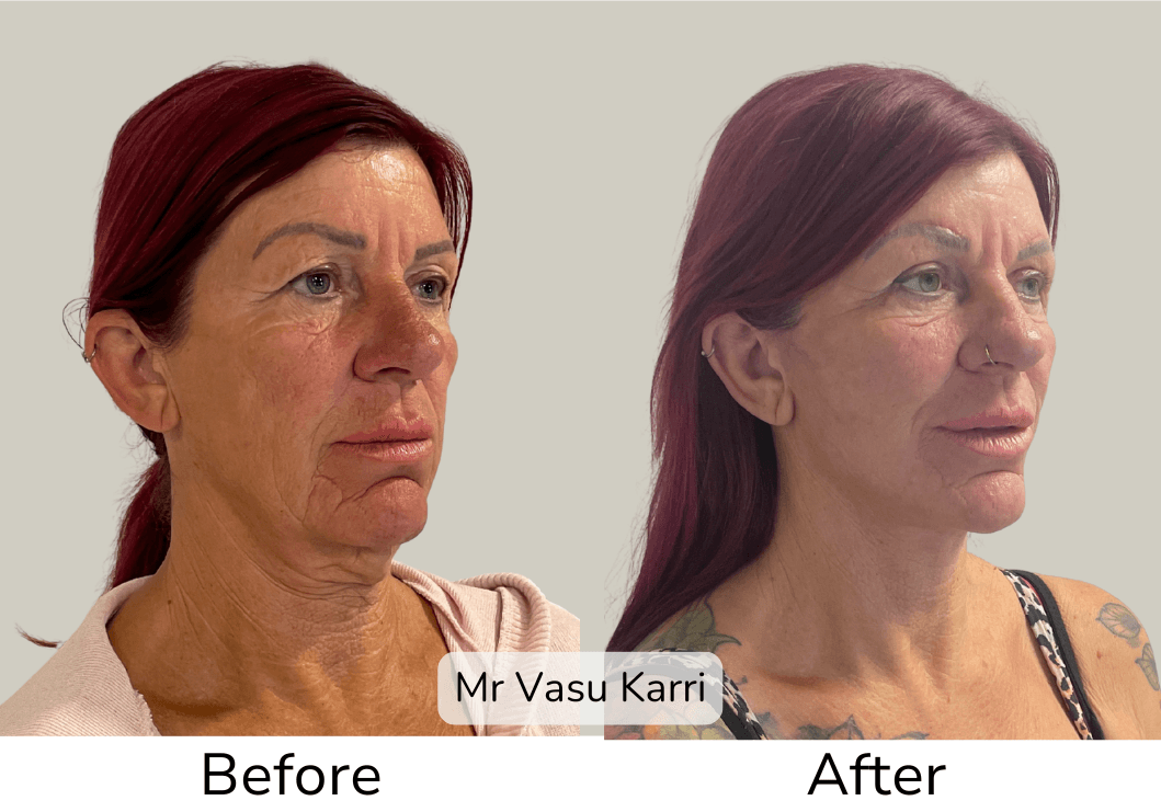 Deep plane facelift and phenol peel transformation 1