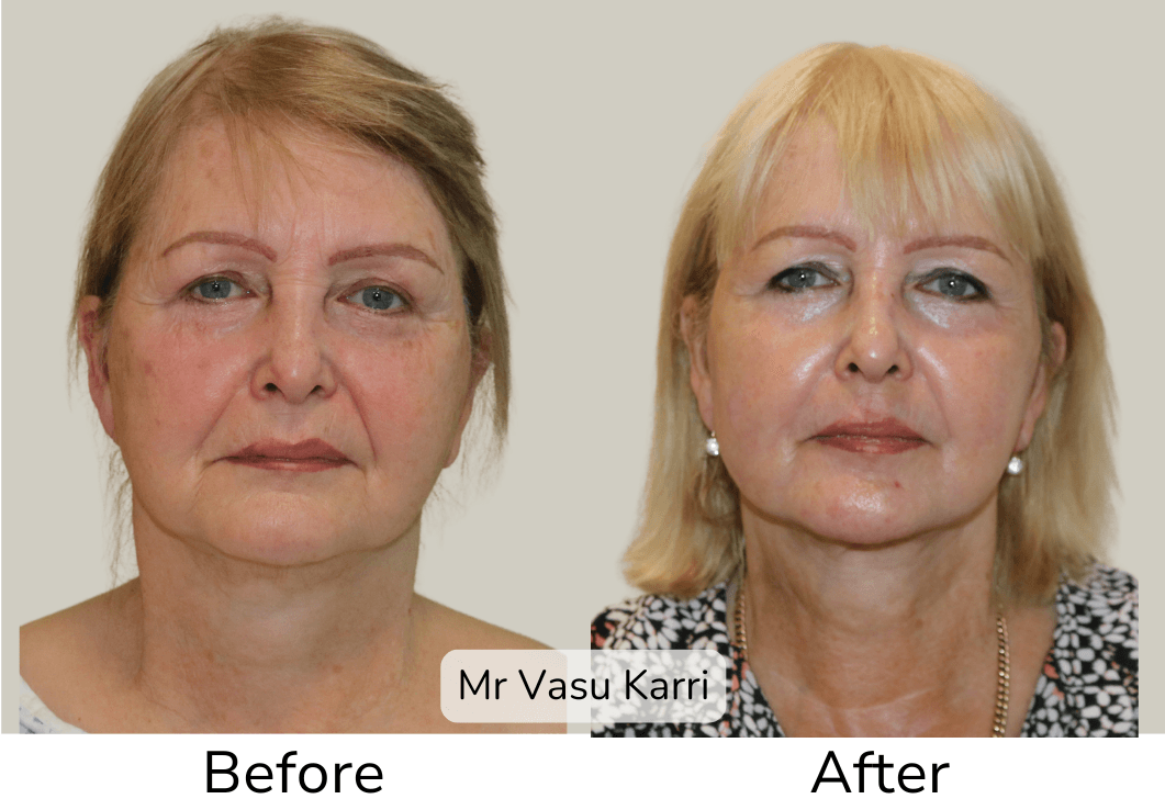 Deep plane facelift and phenol peel transformation 4