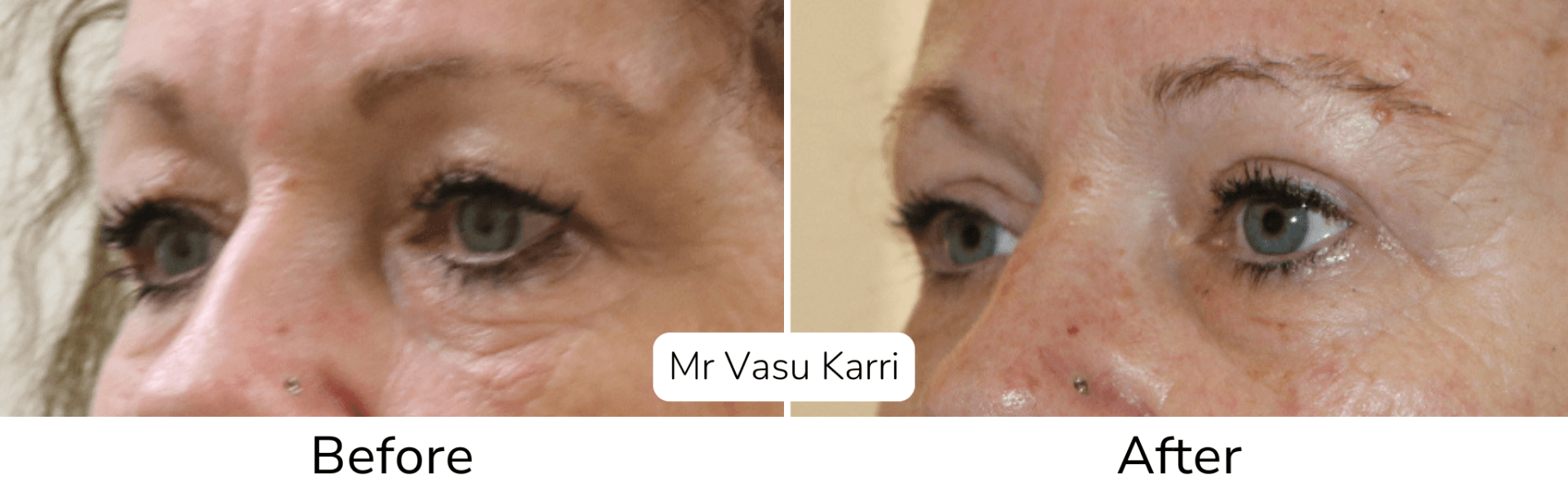 Lower eyelid phenol peel before after
