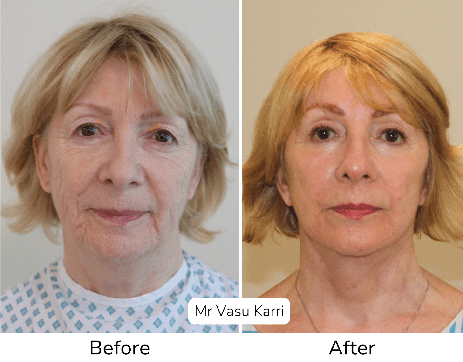 Phenol peel before and after facelift combination showing skin tightening results