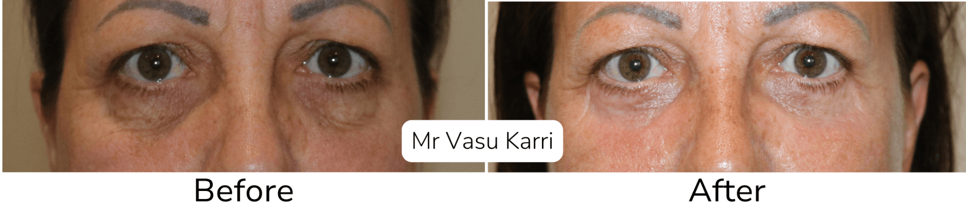 Lower eyelid phenol peel transformation