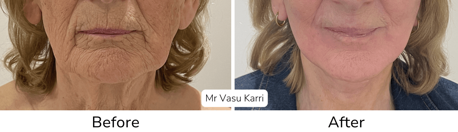 Phenol peel before and after showing lip line smoothing results