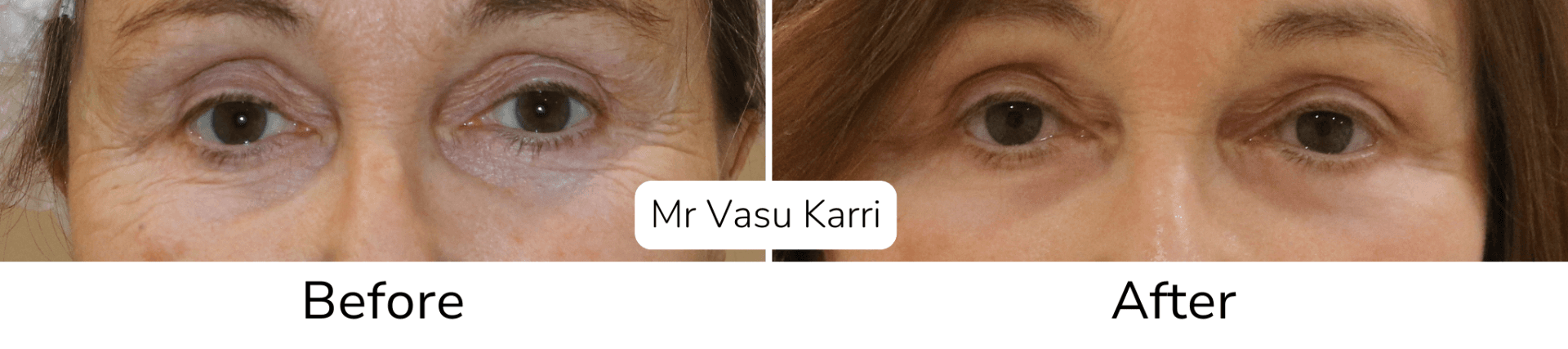 Lower eyelid wrinkles phenol treatment