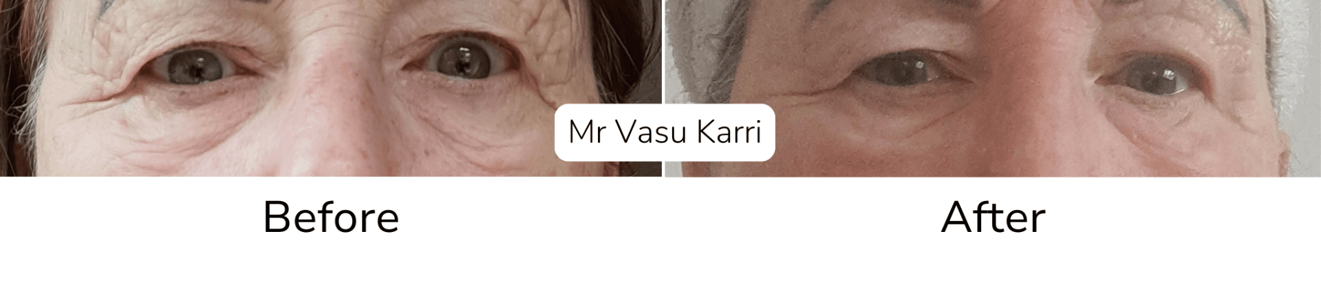 Lower eyelid wrinkles treatment results